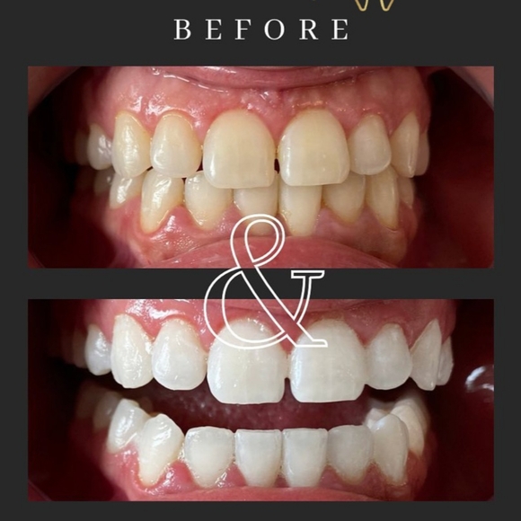 Teeth Whitening Pens. (2) 16% HP. Up to 8 Shades Whiter after the first use. - Picture 3 of 4